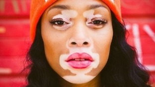 modelo-vitiligo3--644x362